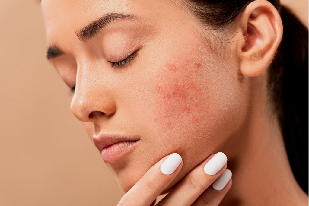 caucasian woman with acne on her cheek 